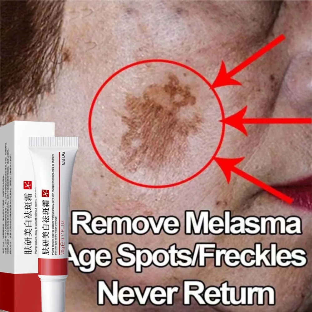 

Effective Whiten Freckle Cream Remove Dark Spot Melasma Fade Melanin Anti-Pigmentation Improve Dullness Brighten Face Skin Care