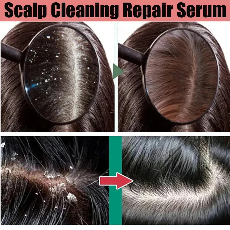 Hair Essence Oil Hair Oil Hair Growth Oil Anti Dandruff Hair Oil Control Relieve Itching Treatment Scalp Cleaning Exfoliating Product Antipruritic Anti Loss Hair