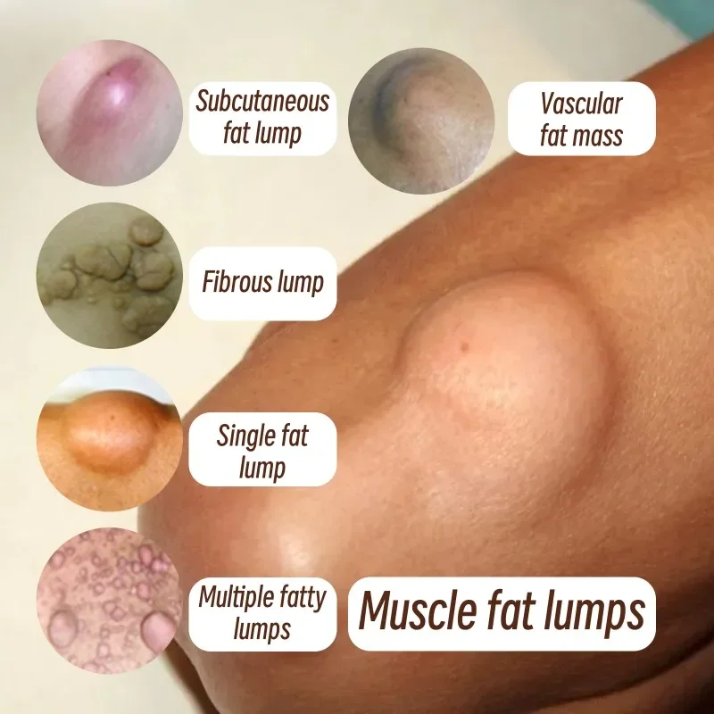 Lipoma Cream Subcutaneous Lumps Remover Treatment Medicine Liquid Skin Swelling Cellulite Fibroma Fat Mass Plaster