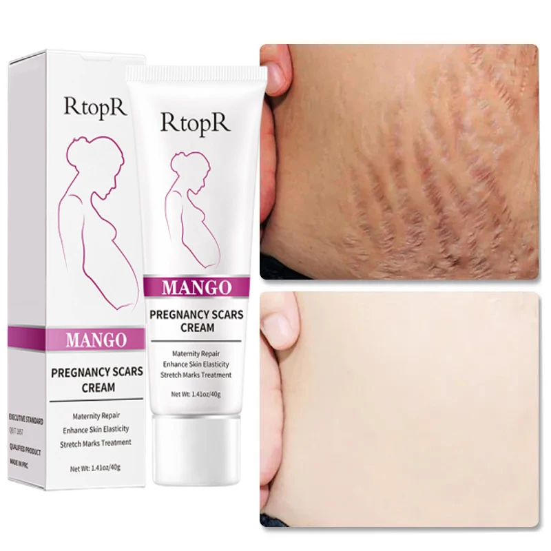 

Stretch Marks Permanent Removal Cream Anti-winkles Postpartum Obesity Care Pregnant Pregnancy Scar Repair Firming Body Skin Care