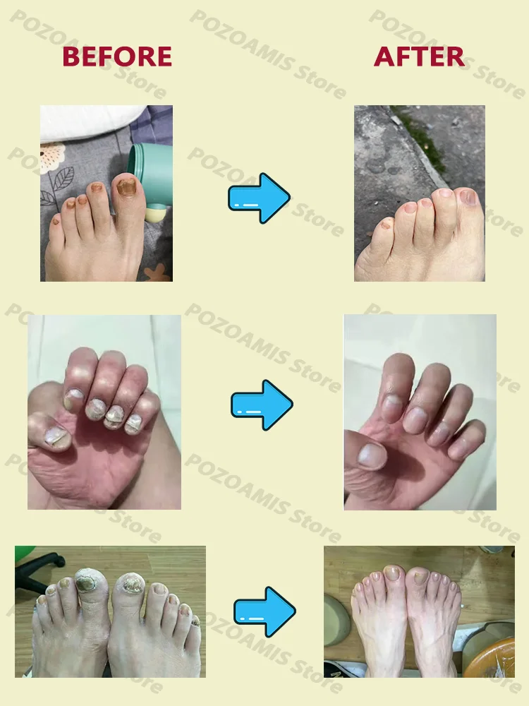 Onychomycosis killer, solve fungal problems, foot care