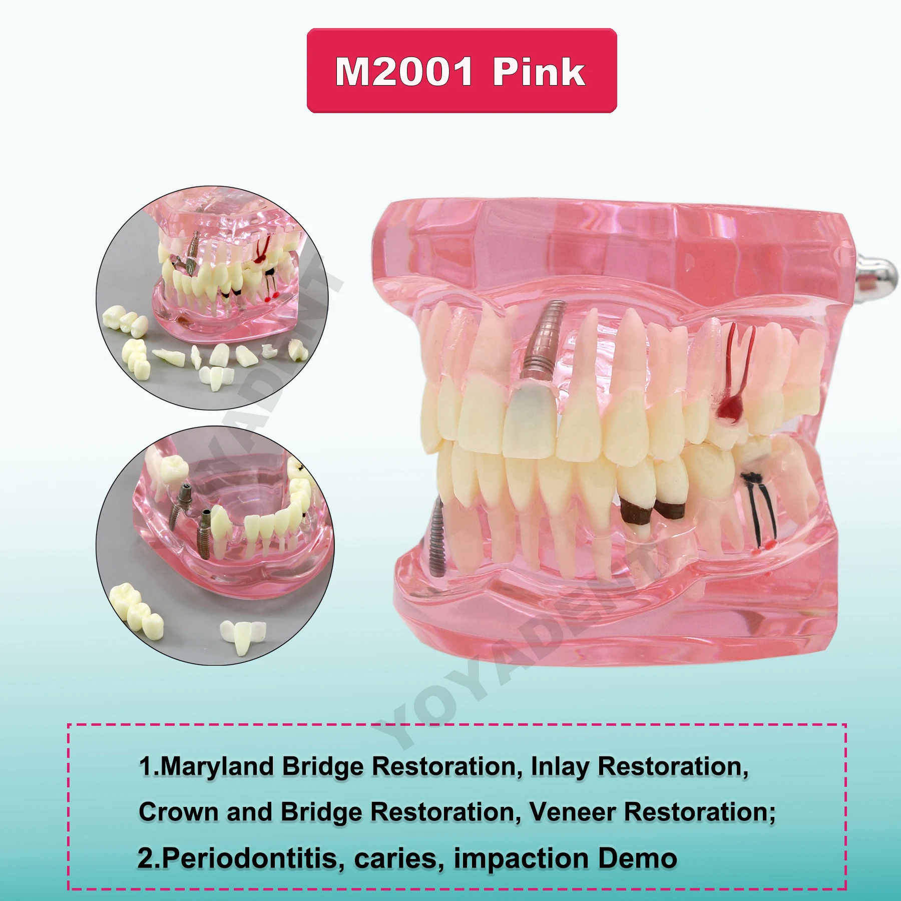 Multiple Types Dental Model Teeth Dental Teaching Models Study Orthodontic Removable Teeth Implant Models Dentist Material 6