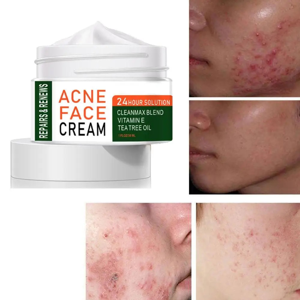 tea tree oil acne scars