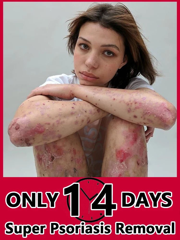 Psoriasis Cream Removal Psoriasis Eczema Best Against Psoriasis