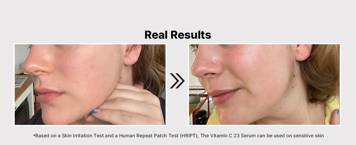 skin irritation test real results used on all skin types sensitive skin hript clinically tested
