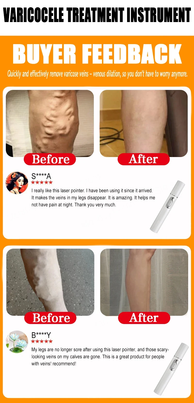 Varicose Vein Lampshade Therapy Effective Relief Of Dilated Vasculitis In The Legs Phlebitis Improved Blood Circulation New 5
