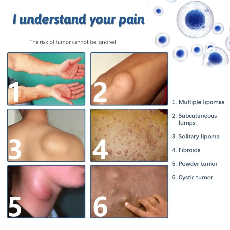 Lipoma Removal Medicines Spray Fibroma Cellulite Remover Apply To Subcutaneous Lumps Fat Mass Treatment Skin Swelling Cream cream lumps remover