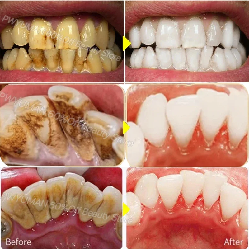 Teeth Whitening Toothpaste Dental Calculus Remover Plaque Stains Cleaning Oral Hygiene Prevent Periodontitis Dental Tools Care