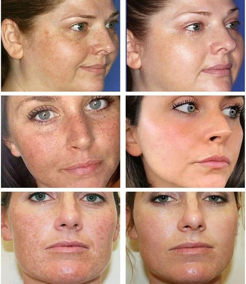 Skin Face Whitening Freckle Cream Remove Melasma Acne Pigment Melanin Dark Spots Anti Freckle Cream Fade Pigmentation Brighten