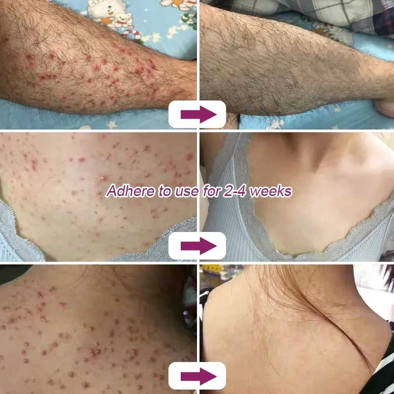 3Pcs Folliculitis Psoriasis Cream Treat Dermatitis Eczematoid Antibacterial Anti-Itch Herbal Medical Skin Care Ointment A1712