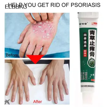 20g 허브 항균 크림, 건선 가려움증 완화, 습진 발진, Urticaria 스케일링 트리트먼트, 1 개