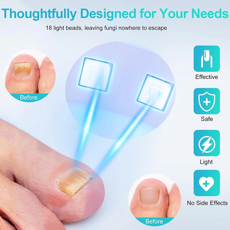 Fungal Nail Device for Rapid Repair of Nails Fungal Onychomycosis Repair of Toenails Removal of Nail Fungi and Treatment