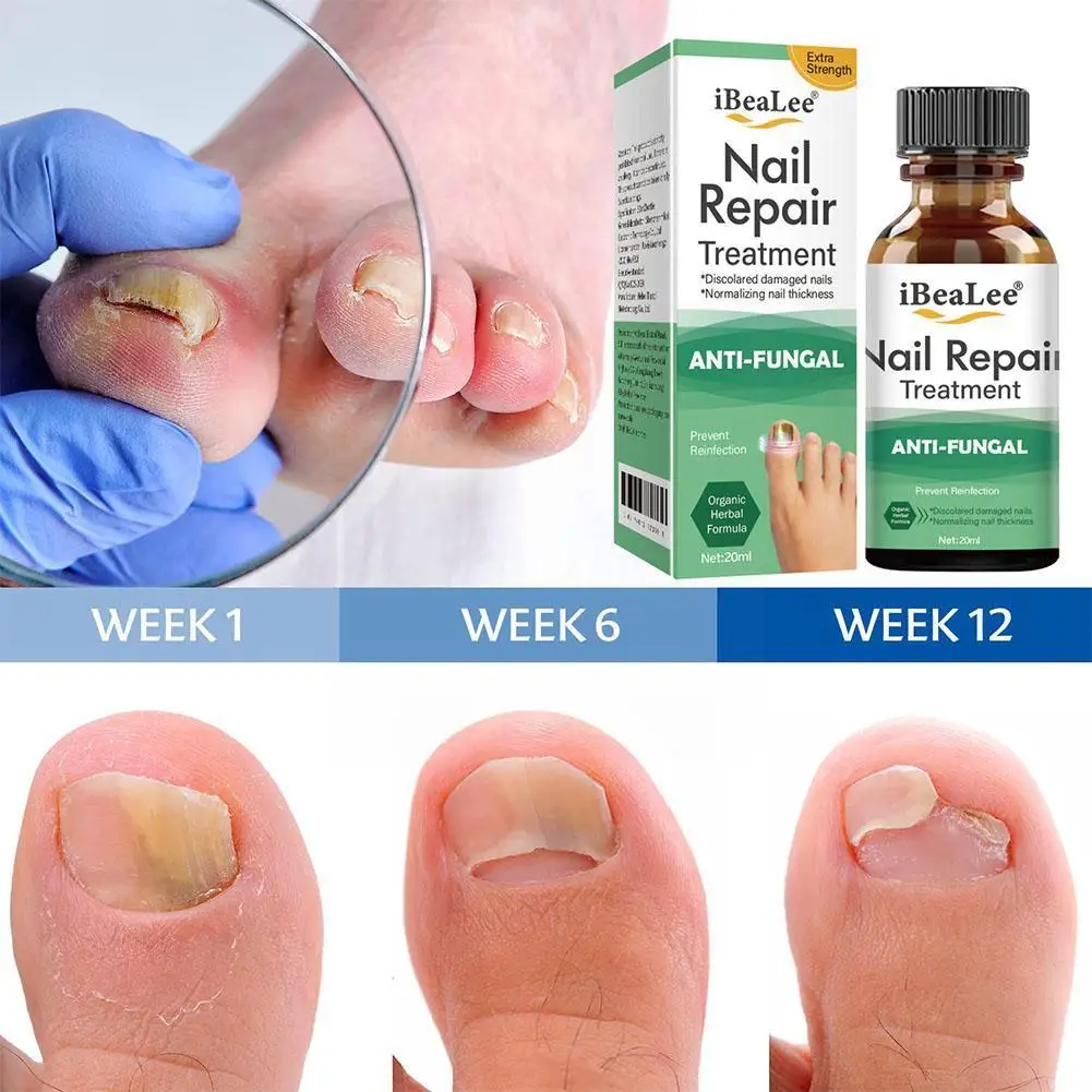 

Nail Fungus Repair Cream Anti Fungal Foot Nails Treatment Ointment Care For Removal Oils Anti Infection Paronychia Onychomy F9B3