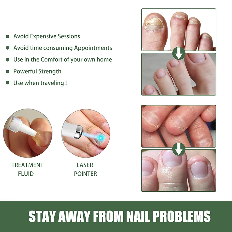 Ganbaro Toenail And Nail Repair Pen Pcs,Nail Treatment Pen,Nail Repair Pen, Toenail Care Solution,Repair And Strengthen Nails,Fingernails Solution |  lupon.gov.ph