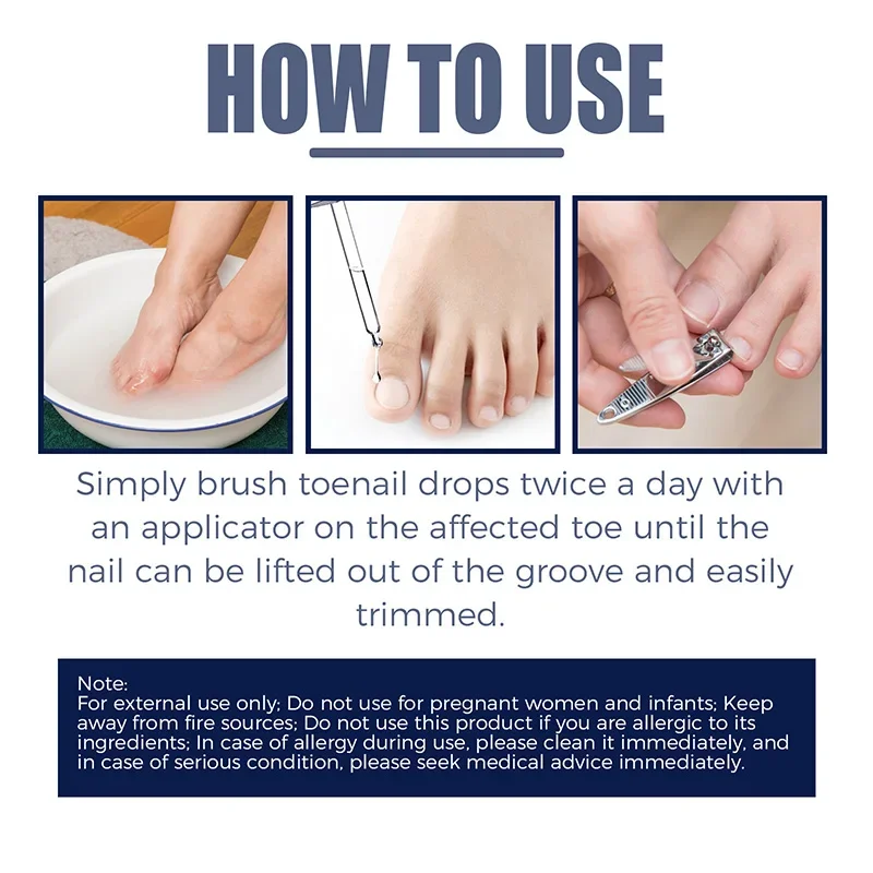 Toenailcare Removal Paronychia Oil Ingrown Toenail Treatment U&ntilde;as Renewal Liquid Bad Nail Thicken Nail Soft Repair Solution manicure pedicure tools nail fungus remover
