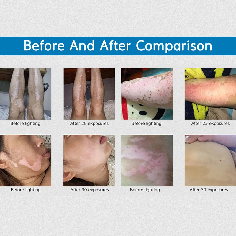 311nm Uvb Phototherapy Narrow band Uv Phototherapy Lamp Uvb Light Therapy Psoriasis For Vitiligo 5