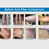311nm Uvb Phototherapy Narrow band Uv Phototherapy Lamp Uvb Light Therapy Psoriasis For Vitiligo 5