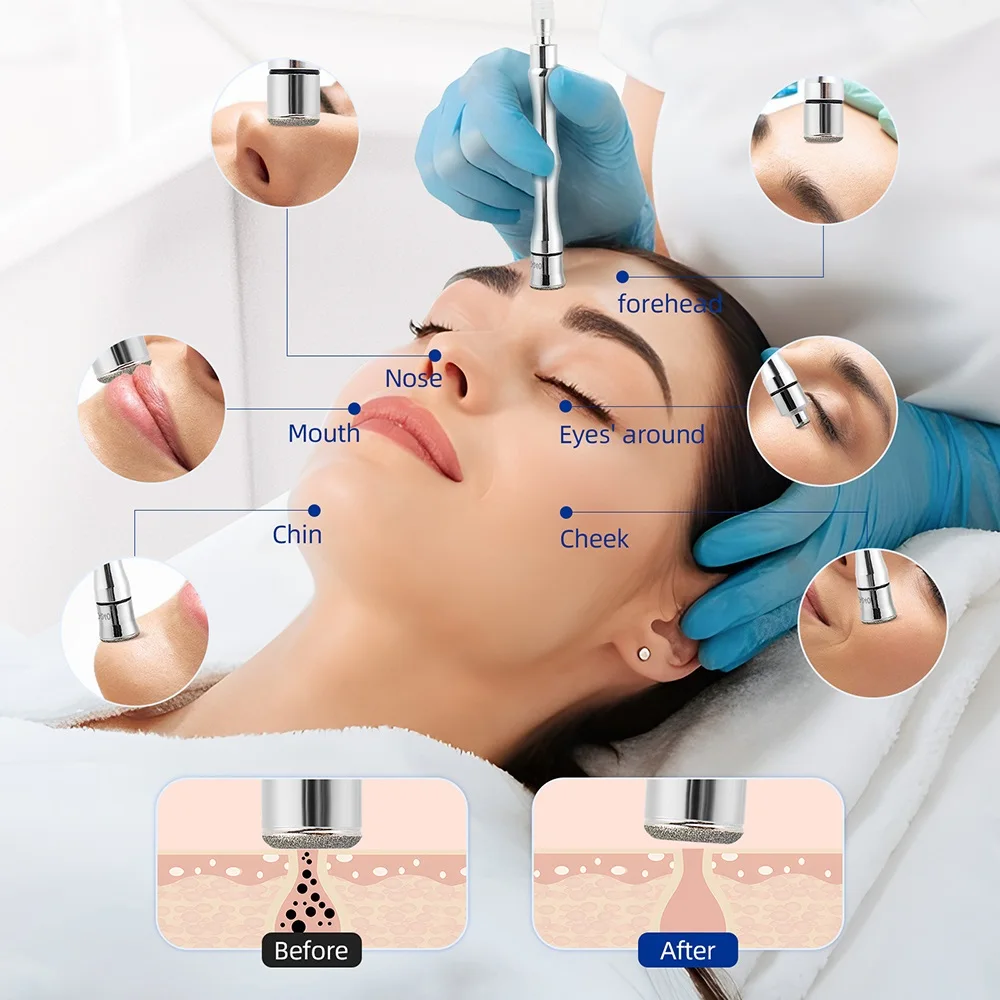 Diamond Microdermabrasion Dermabrasion Accessory Tips For Facial Skin Peeling Blackhead Remover 9 Tips 3 Wands or 9 Tips 6 Tips