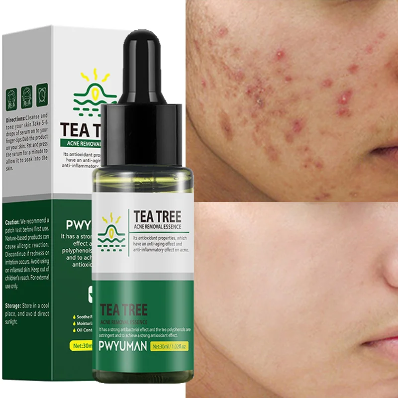 

Effective Acne Removal Serum Acne Treatment Fade Acne Spots Scar Essence Oil Control Moisturizing Shrink Pores Firming Skin Care