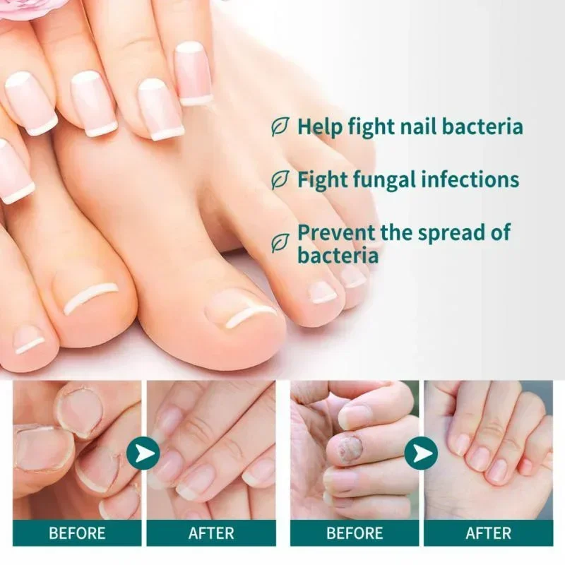 Beauty Health Nail Fungus Treatment Anti-Infection Nail Fungal Removal Essence Nails Fungus Treatments Serum Spray Repair Toe