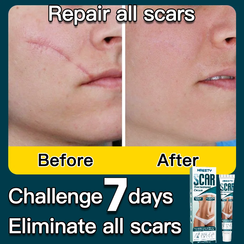 FastScarRemovalCreamTreatmentSurgeryBurnHyperplasticScars