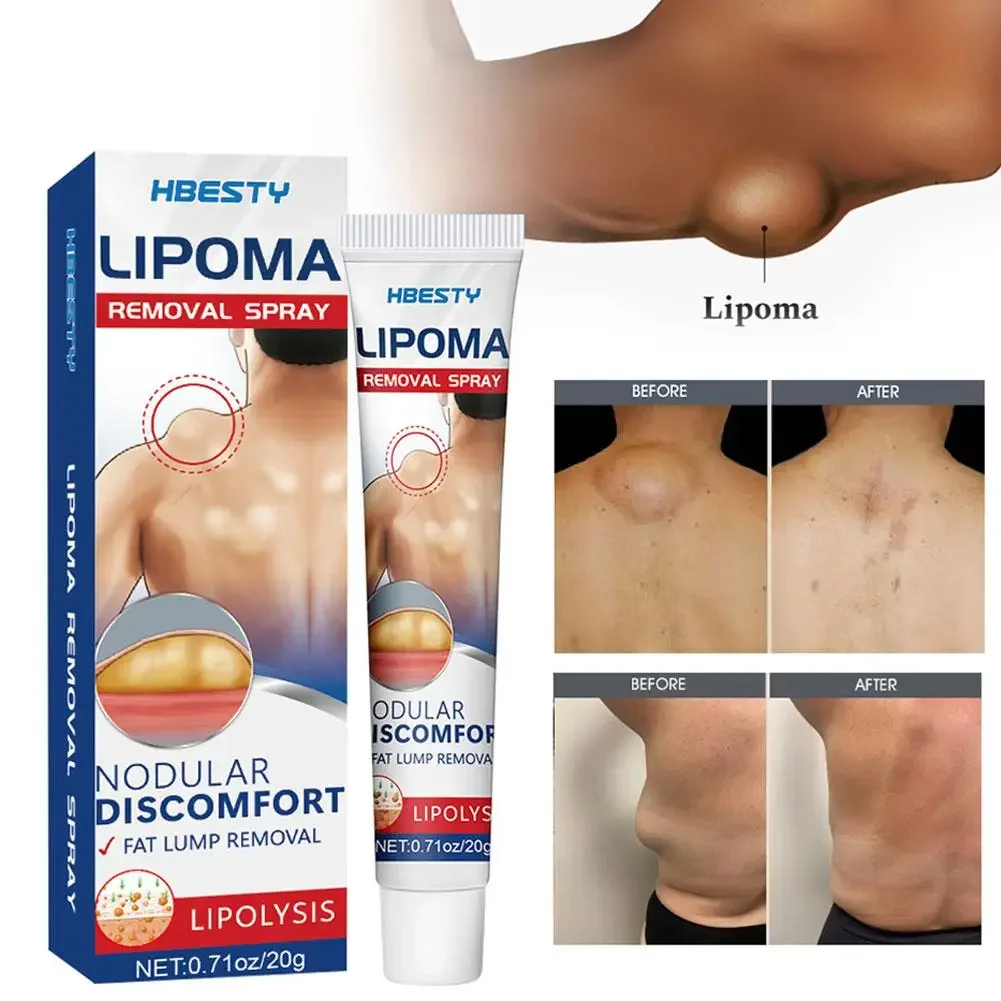 Lipoma Removal Cream Effective Antitumor Remove Fat Lump Ointment Herbal Extracts Nodular Skin Cyst Swelling Painless Treatment pain relief cream,skin care ointment,knee pain relief cream,hemorrhoids treatment cream,antibacterial anti fungal cream,sex delay cream