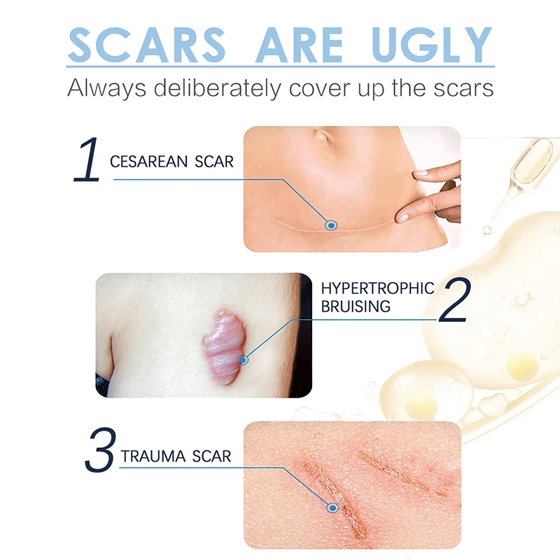 Laser therapy Keloid scar laser treatment