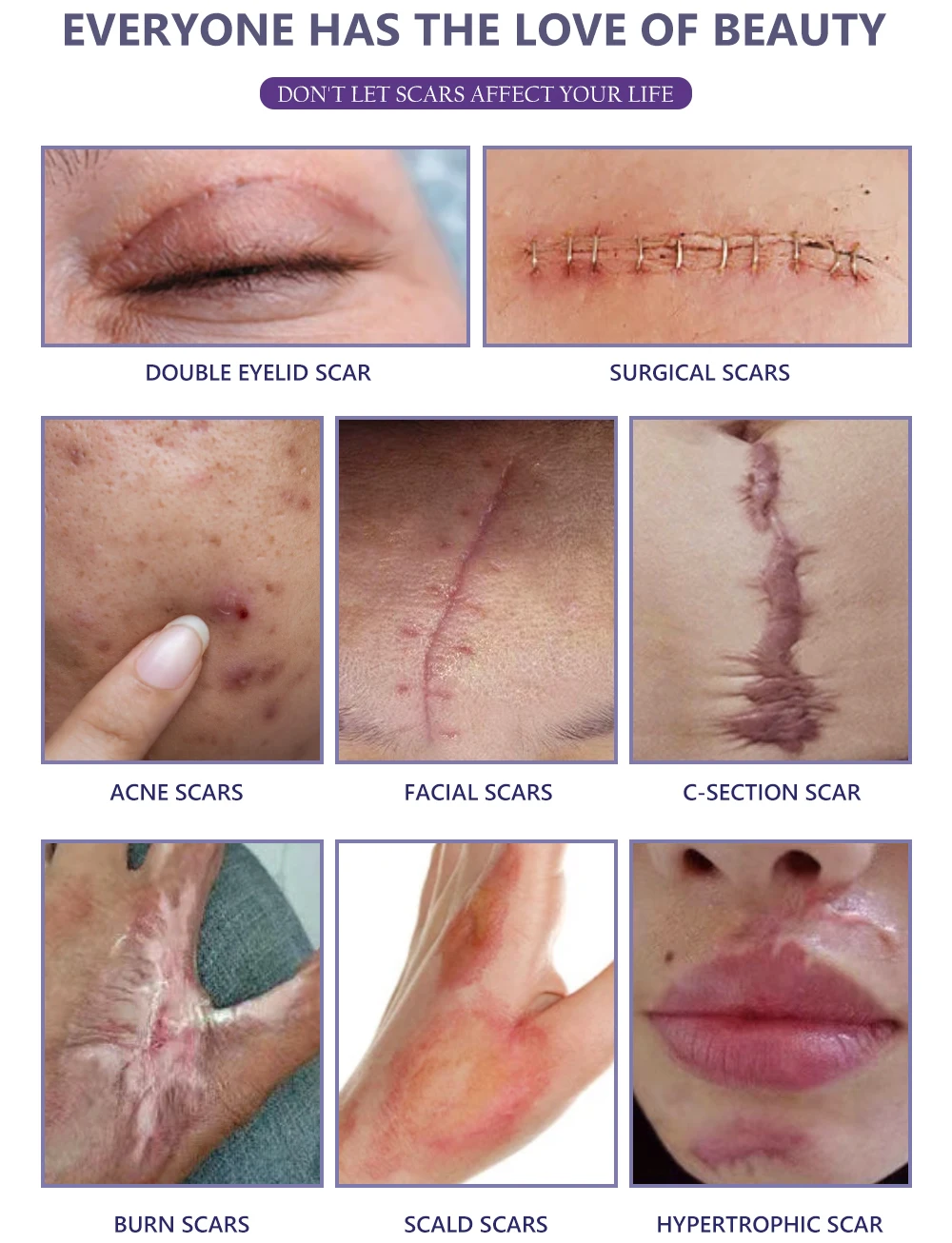 scar removal cream