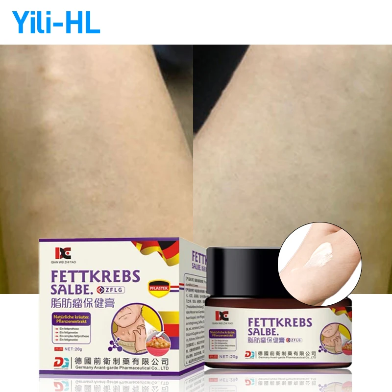 

Lipoma Removal Medicine Fat Mass Treatment Cream Fibroma Cellulite Remover Patch Fat Lump Lipomas Cyst German Secret Recipe