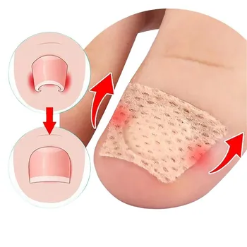 30 pezzi strumento di correzione dell'unghia del piede incarnita trattamento delle unghie dei piedi incarnite adesivo patch pedicure strumento per la cura del piede 1