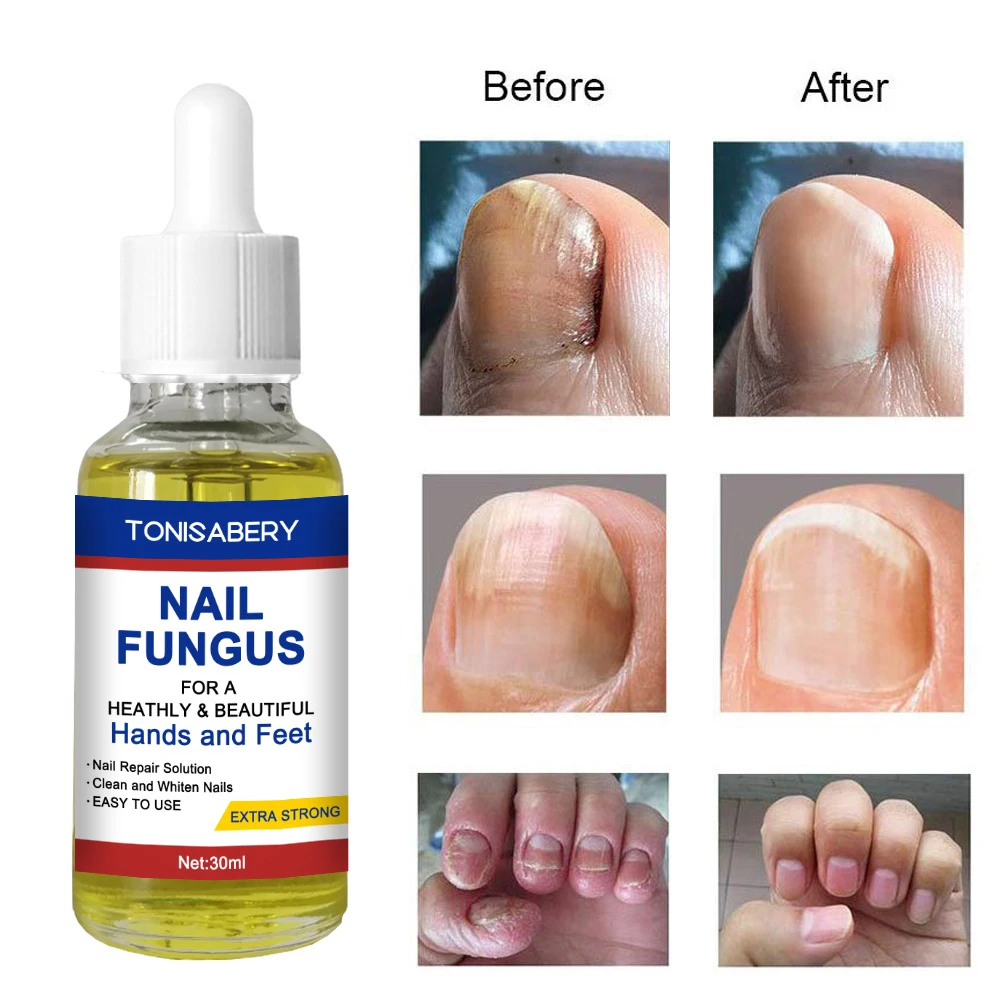 30ml Nail Fungus Treatment Essence Serum Care Oil Hand and Foot Care