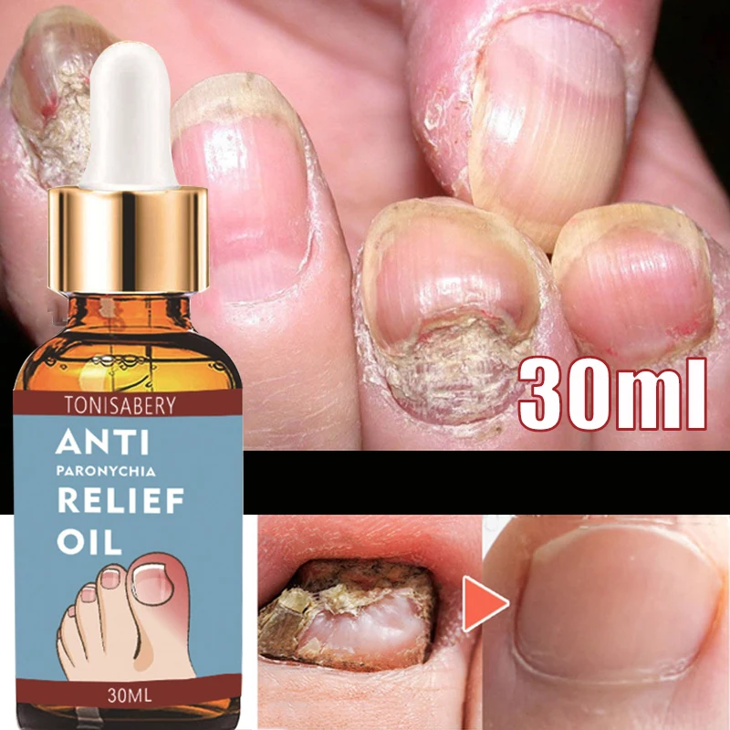 

Nail Fungal Treatment Oil Repair Ingrown Thickened Grey Nails Serum Toe Nail Fungus Removal Serum Anti-Thyroidism Foot Care 30ml