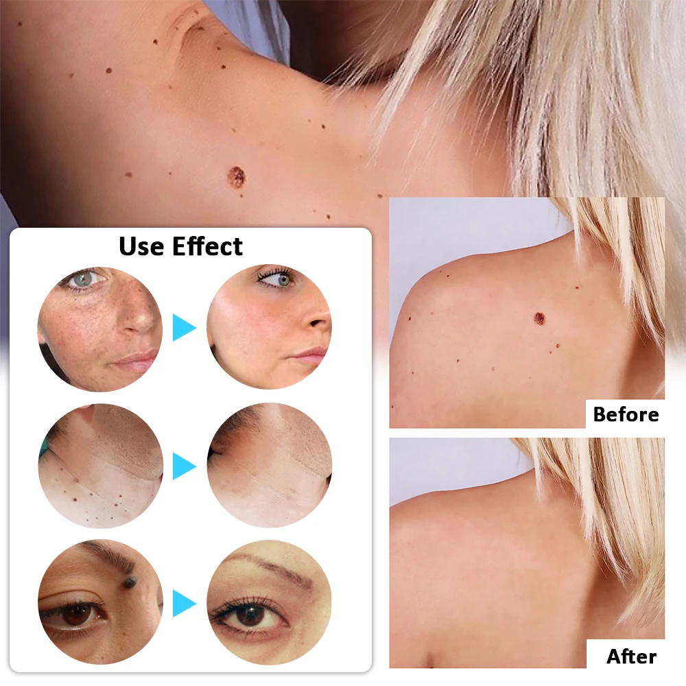 Plasma Laser Pen Skin Tag Remover Wart Mole Spots Freckles Dark Dpot Black Dots Nevus Flat Blemish Pimples Removal Face Body