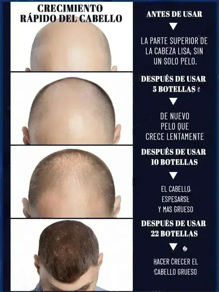 Hair Treatment Hot selling product, 99% of buyers buy again, have more and more hair, say goodbye to baldness, thick hair