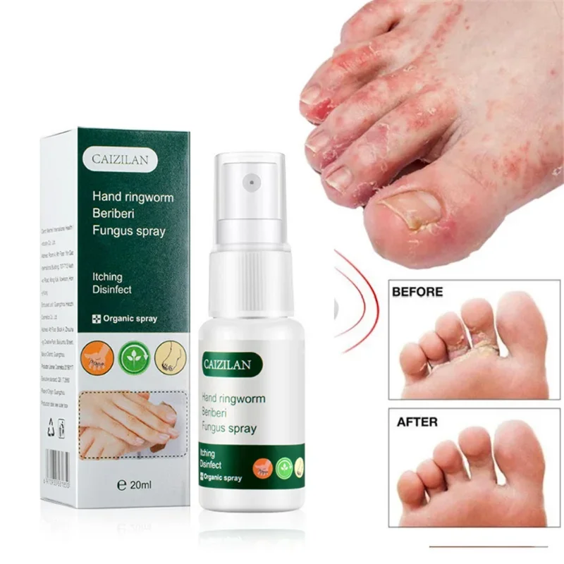 Nail Fungus Remover Pain Analgesic Cream Anti Fungal Spray Foot Fungus Cream For Cracked Heel Peeling Blister Repairing Feet