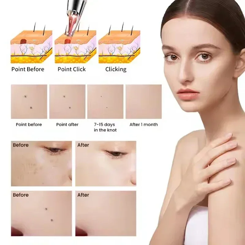 Picosecond Laser Pen Blue Light Machine Dark Spot Remover Freckle Tattoo Removal Portable Scar Mole Remover Skin Care Beauty