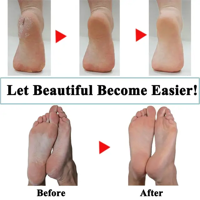 Foot care tool Heads Pedi Hard Skin Remover Refills Replacement Rollers For Scholls File Feet care Tool 6