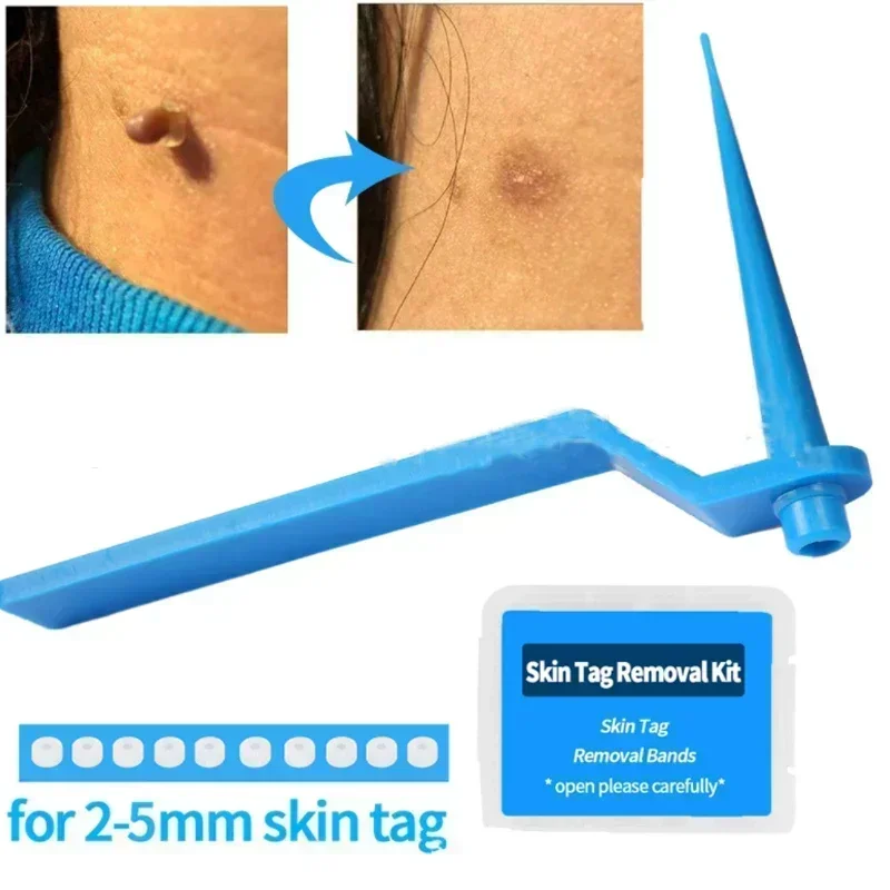 Skin Tag Removal Kit Treatment Tools Set Cleansing Swabs skin tag removal tool skin tag removal pen