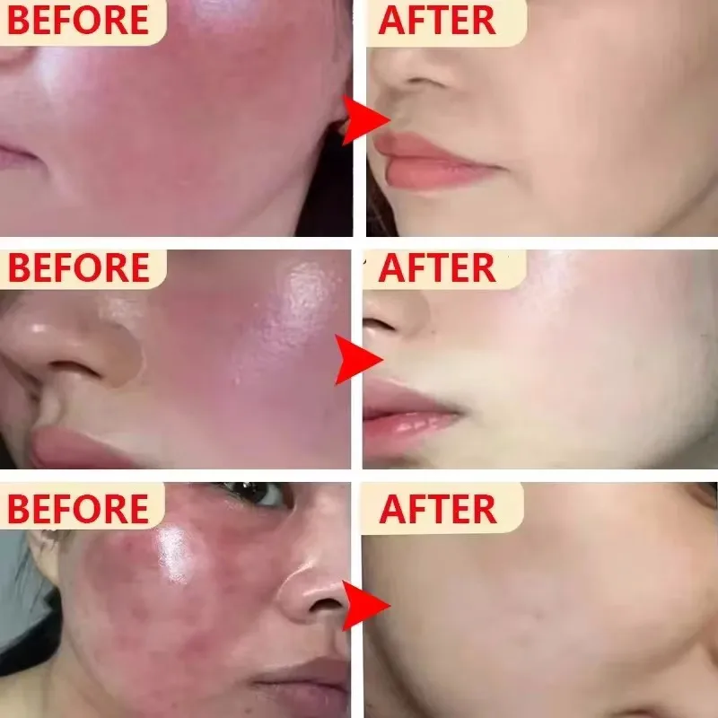 كريم إصلاح احمرار الوجه تحسين جفاف البشرة الحساسة...