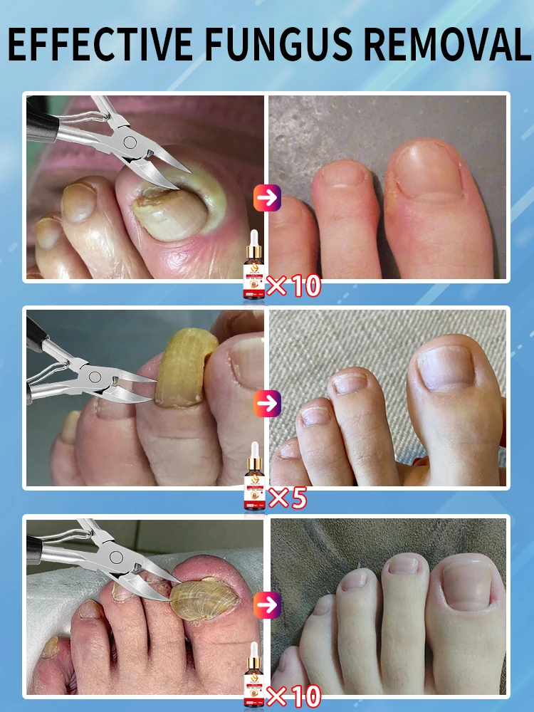 Ingrown nail nippers, toenail clippers, deep nail groove manicure tools, help essential oil absorption, solve problems