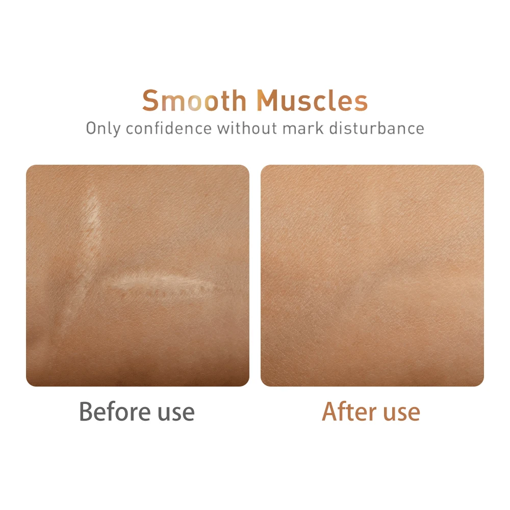 LANBENA New Scar Remover Serum Lighten Melanin Repair Soothes Softens Skin Wounds Acne Scar Repair Remove Stretch Marks 10PCS