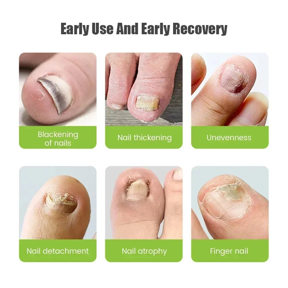Nail Fungus Laser Treatment Device for Toenail Fingernail Fungus Treatment Strength Treat Onychomycosis Toe Cure Machine