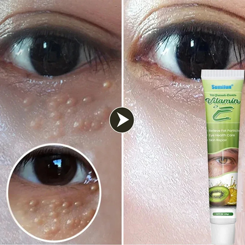 

Fat Granules Remover Eye Cream Effective Remove Fat Granules Puffiness Anti-Particles Milia Remover Product Repair Eye Skin Care