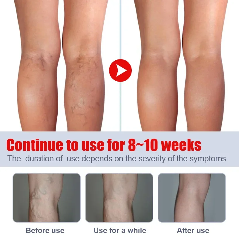Varicose Vein Relief Cream Vasculitis Phlebitis Spider Legs Treatment Soothing Relieve Pain Herbal Ointment