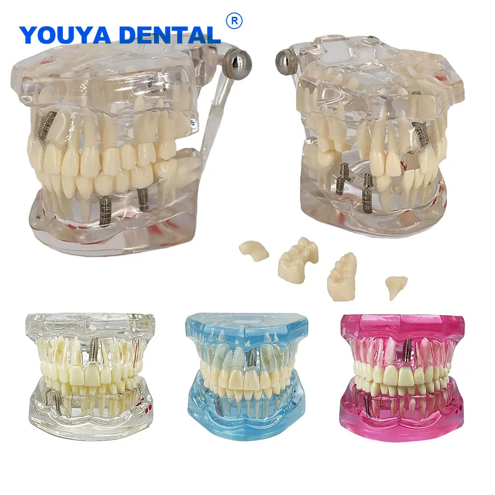 

Adult Dental Model Transparent Disease Teeth Implant Restoration Bridge Dentistry Medical Science Teaching Study Communication