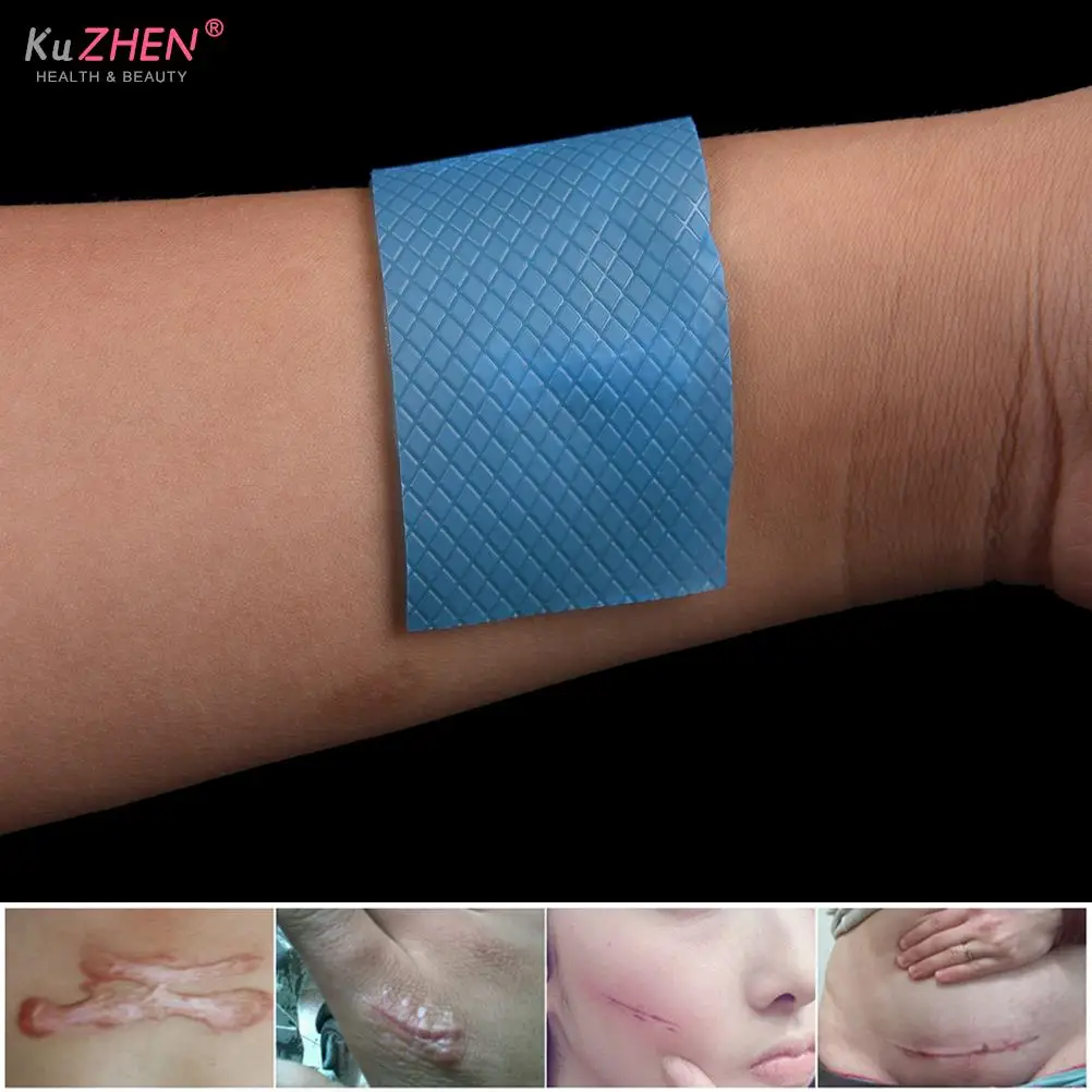 Removal Cesarean Section Hypertrophic Keloid Skin Scars Therapy