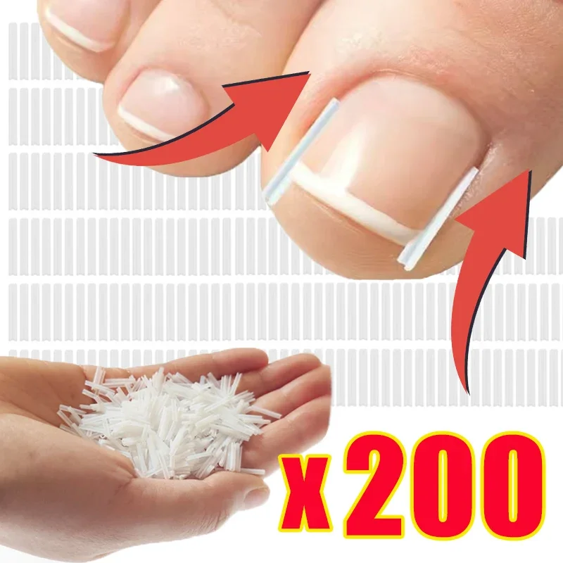 Ultra-thin Ingrown Toenail Corrector Tools C-shaped Tube Pad Correcting Nails Growth Paronychia Treatment Recover Pedicure Tools