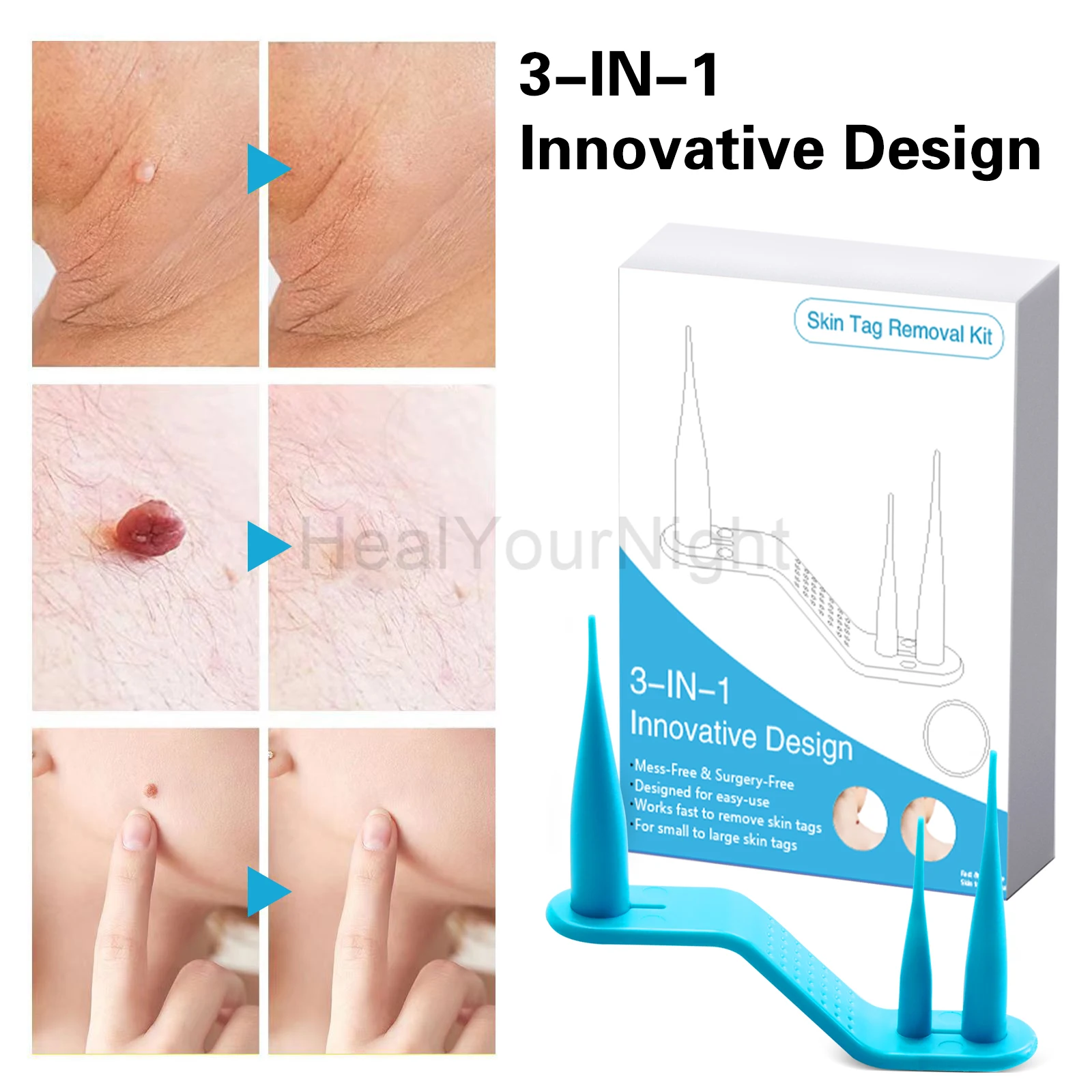 3-IN-1 Auto Skin Tag Removal Kit Painless Skin Label Mole Acne Wart Removal Pen Set with Cleansing Swabs Facial Beauty Care Tool 4