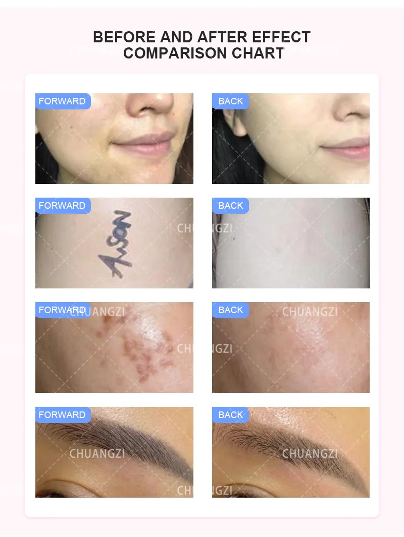 OPT 3-in-1-Gerät IPL Laser-Haarentfernung Pikosekunden-Tattoo-Pigmententfernung RF Anti-Aging-Handstück Eine Maschine Drei Anwendungen – Detail 11