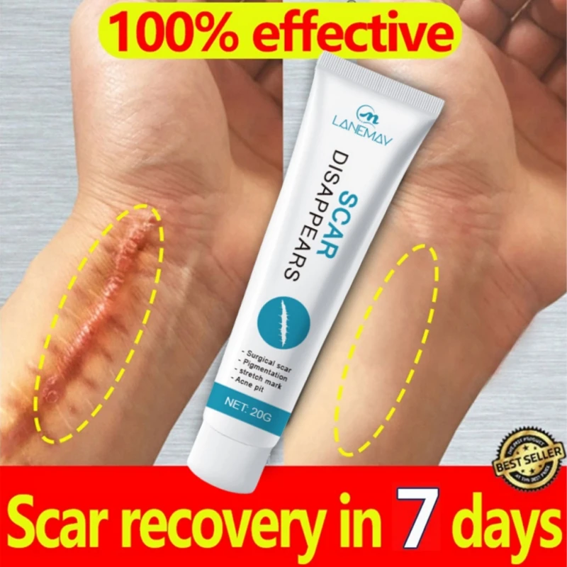 

Scar Removal Cream Remove Keloid Surgical Burn Scald Caesarean Section Scars